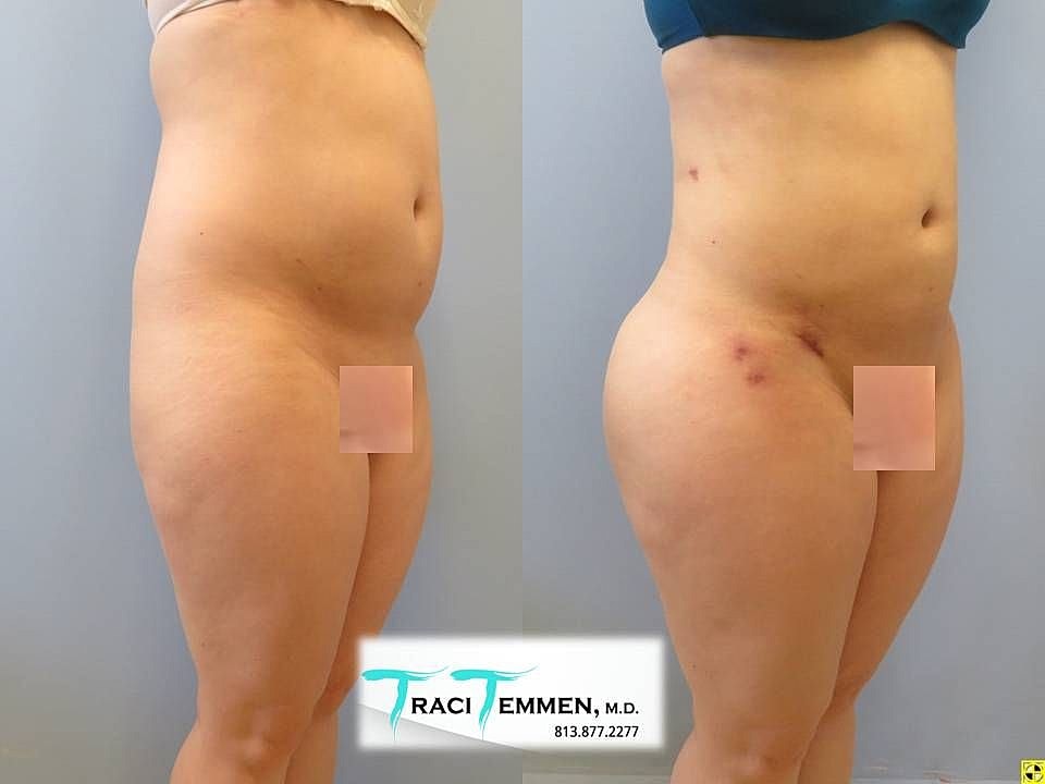 Liposuction Before & After