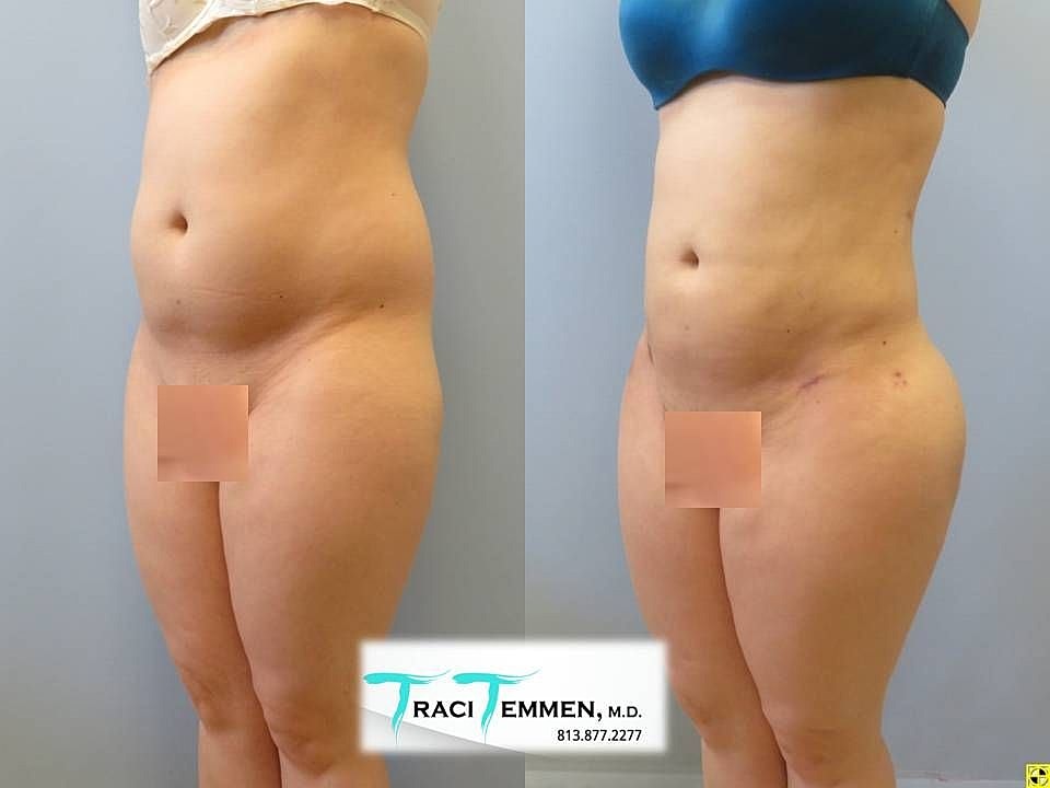 Liposuction Before & After