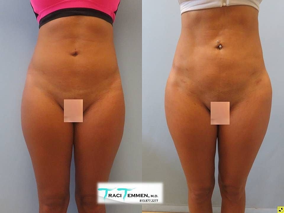 Liposuction Before & After