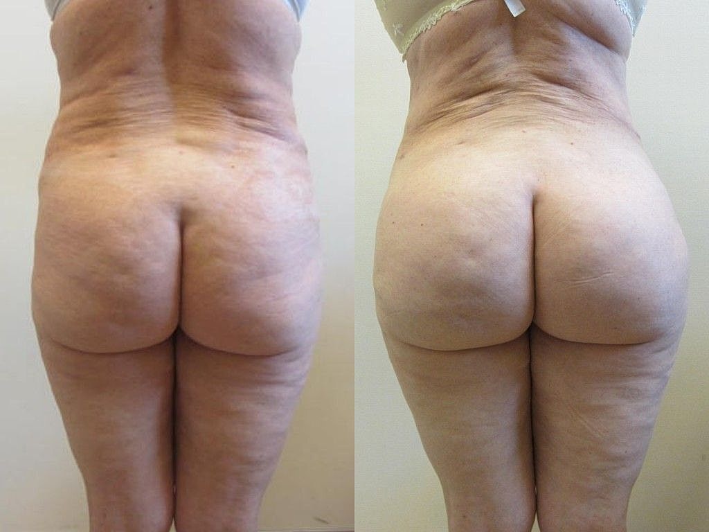Liposuction Before & After
