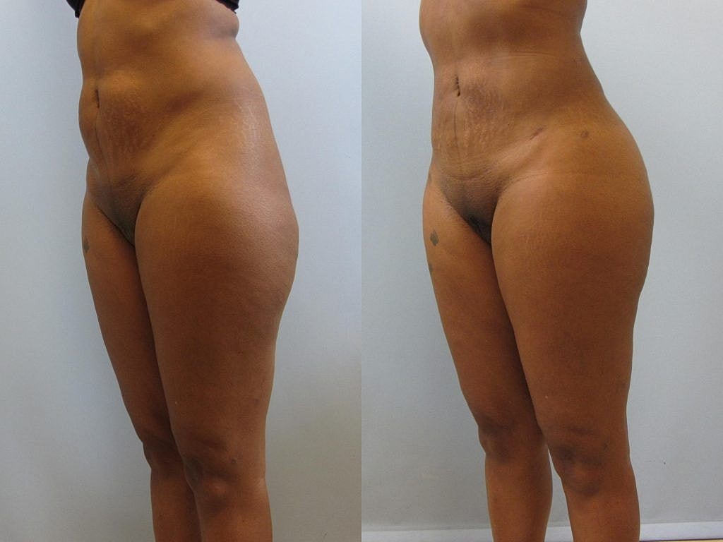 Liposuction Before & After