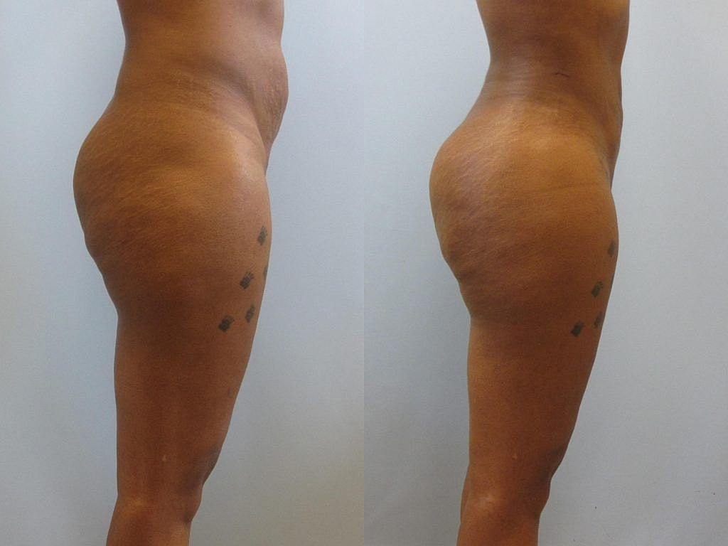 Liposuction Before & After