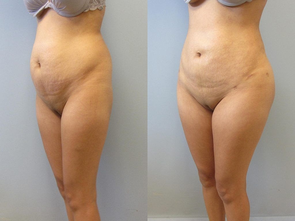 Liposuction Before & After