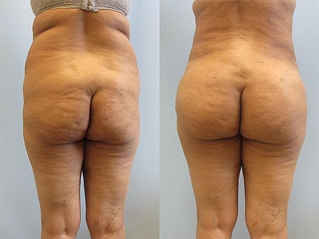 Liposuction Before & After