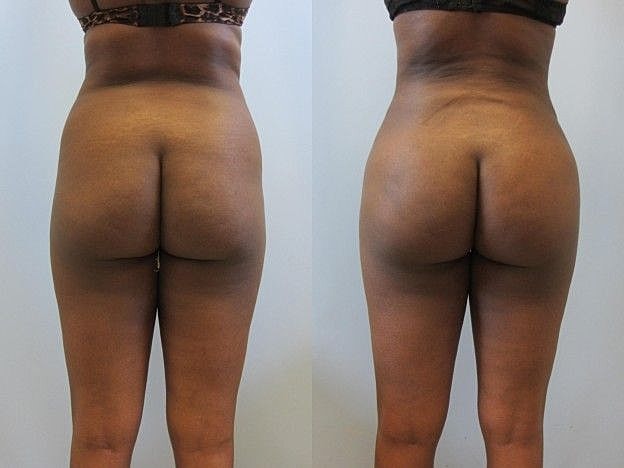 Liposuction Before & After