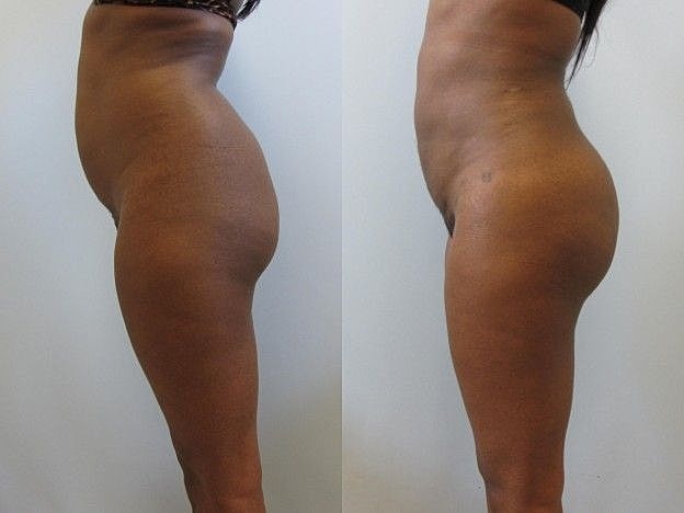 Liposuction Before & After