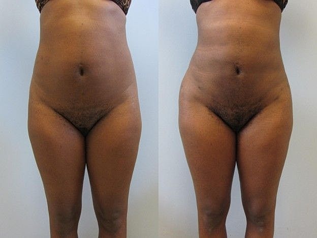 Liposuction Before & After