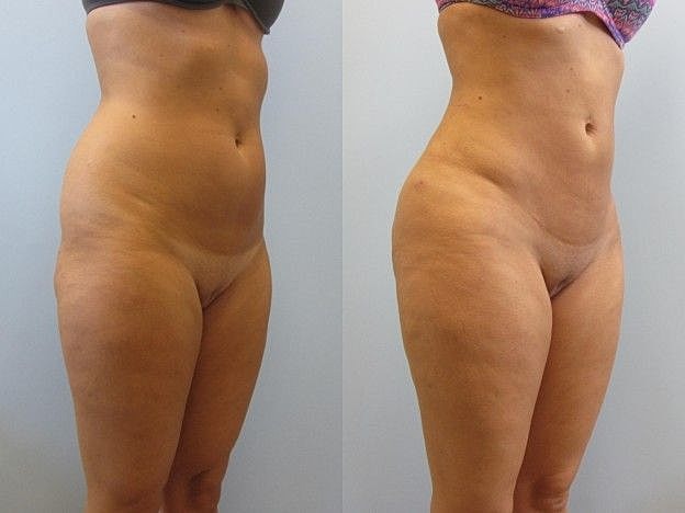 Liposuction Before & After