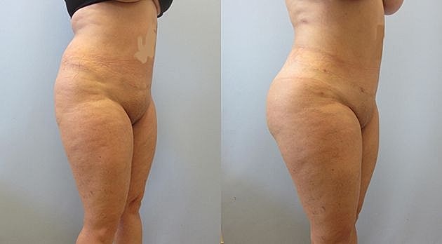 Liposuction Before & After