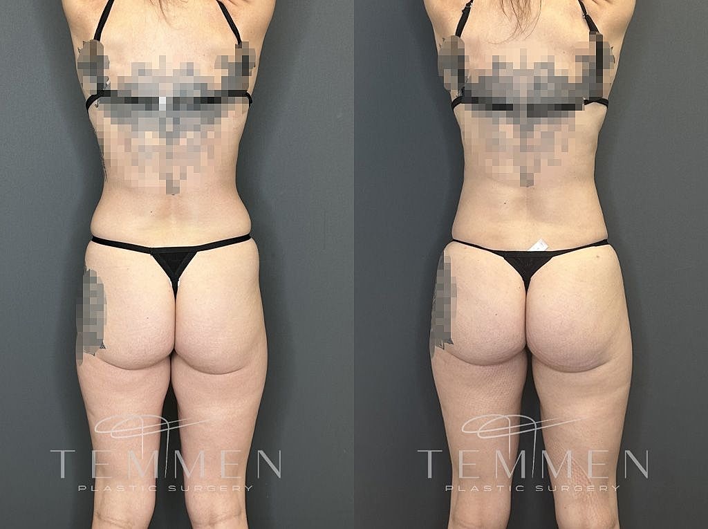 Liposuction Before & After