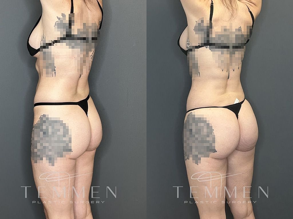Liposuction Before & After