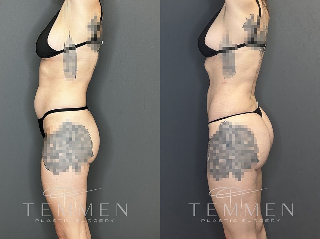 Liposuction Before & After