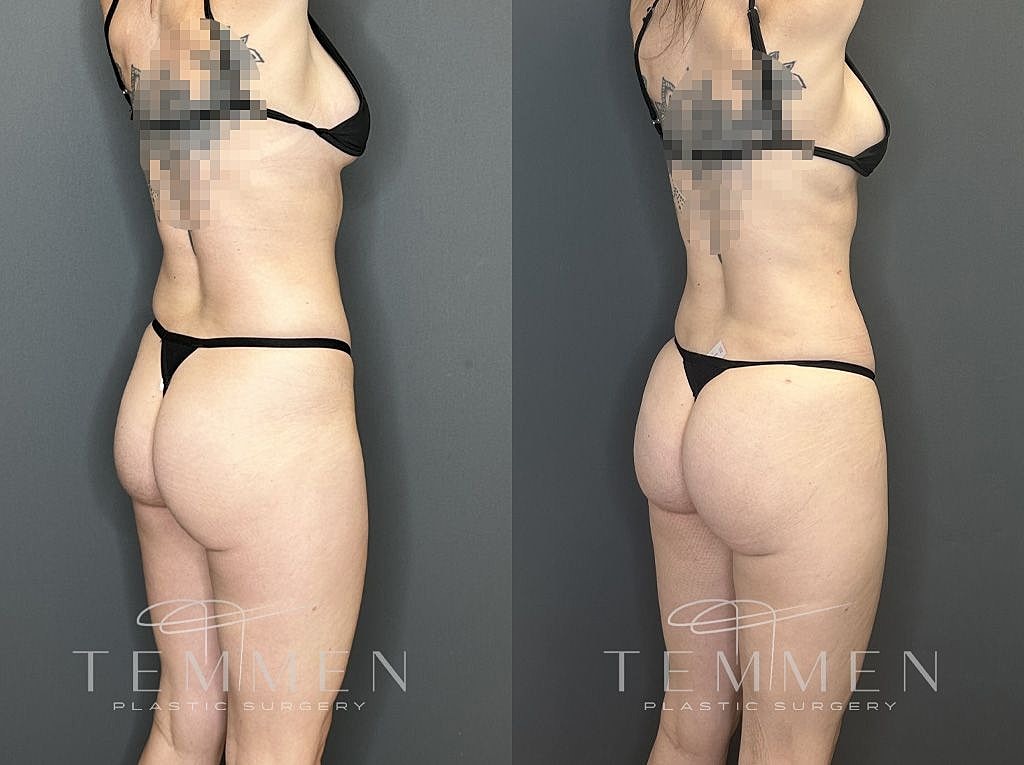 Liposuction Before & After