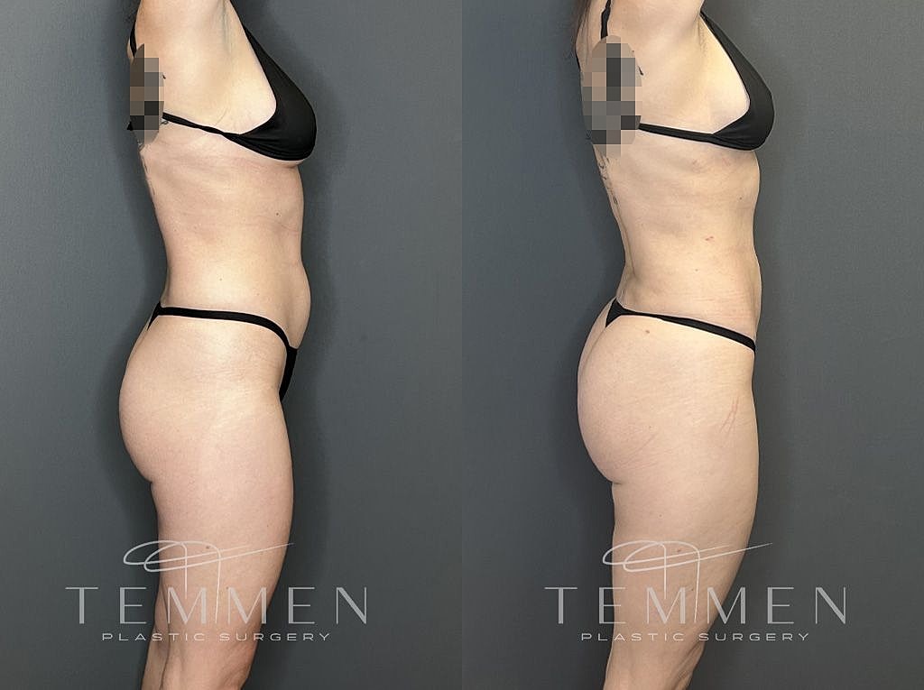 Liposuction Before & After