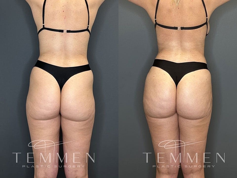 Liposuction Before & After