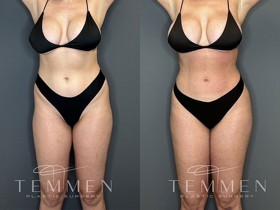 Liposuction Before & After