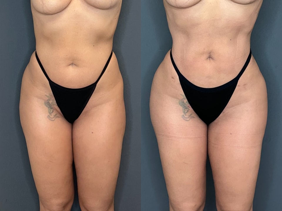 Liposuction Before & After