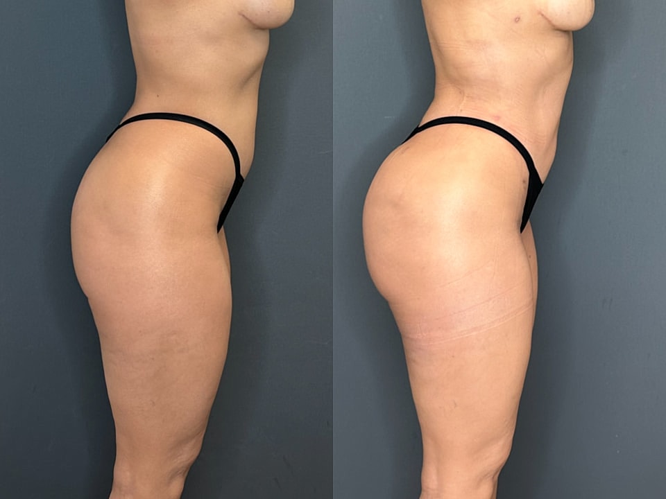 Liposuction Before & After