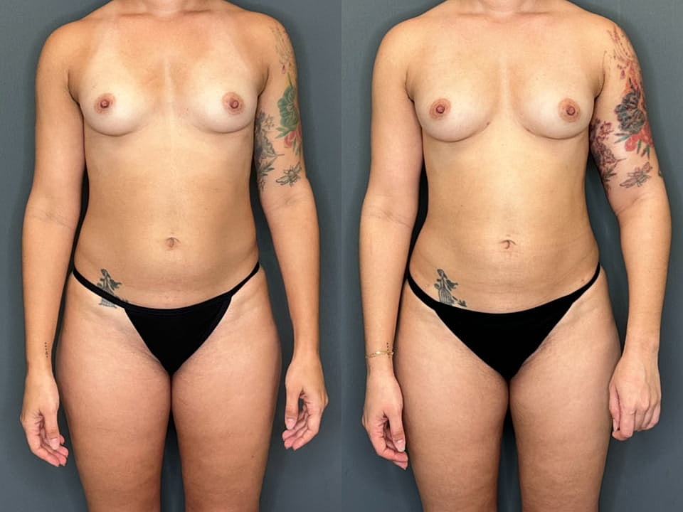 Liposuction Before & After