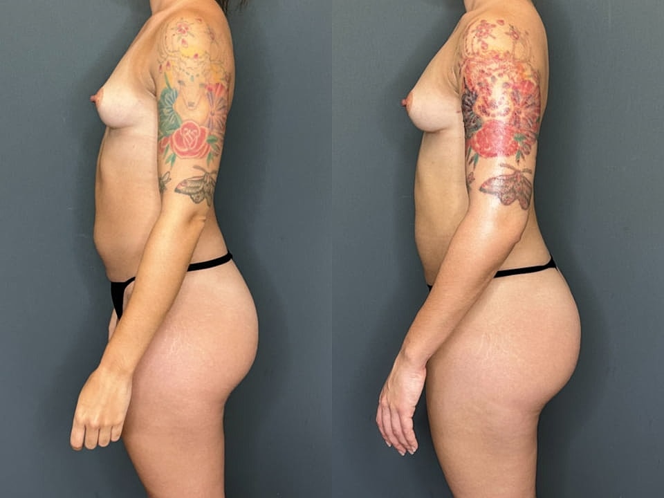 Liposuction Before & After