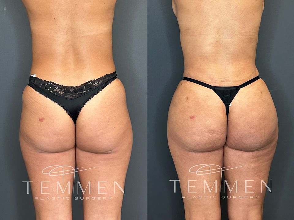 Liposuction Before & After