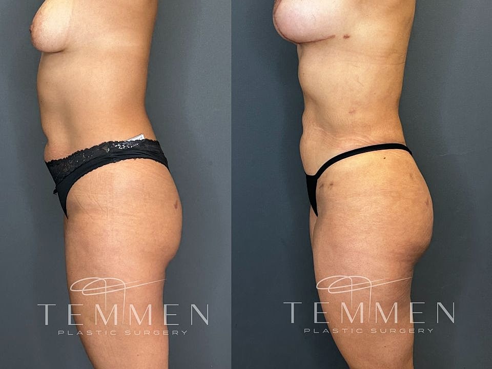 Liposuction Before & After