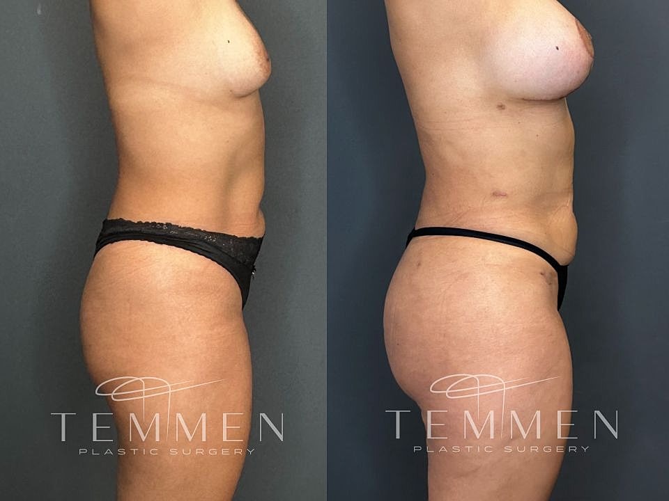 Liposuction Before & After