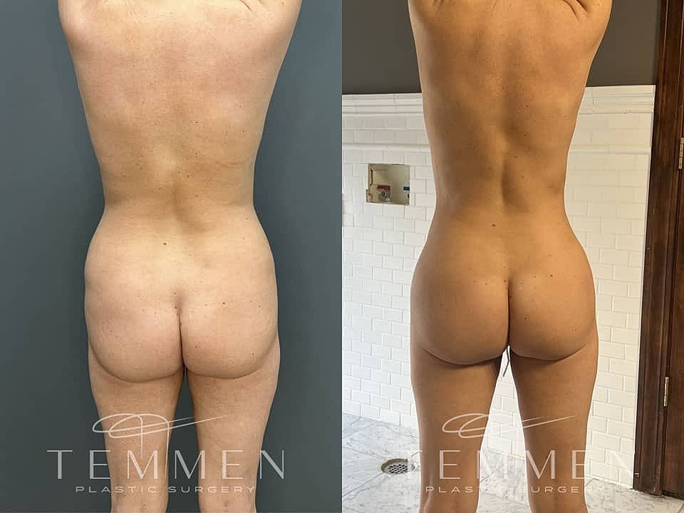 Liposuction Before & After