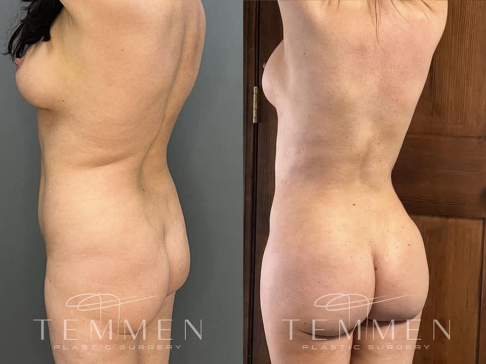 Liposuction Before & After