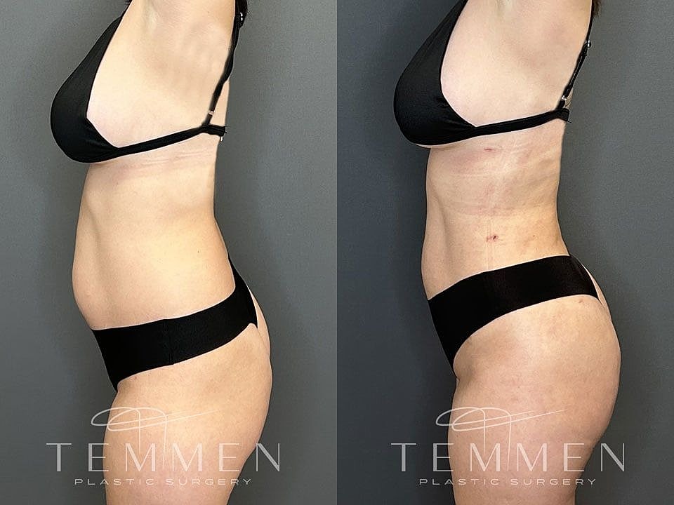 Liposuction Before & After