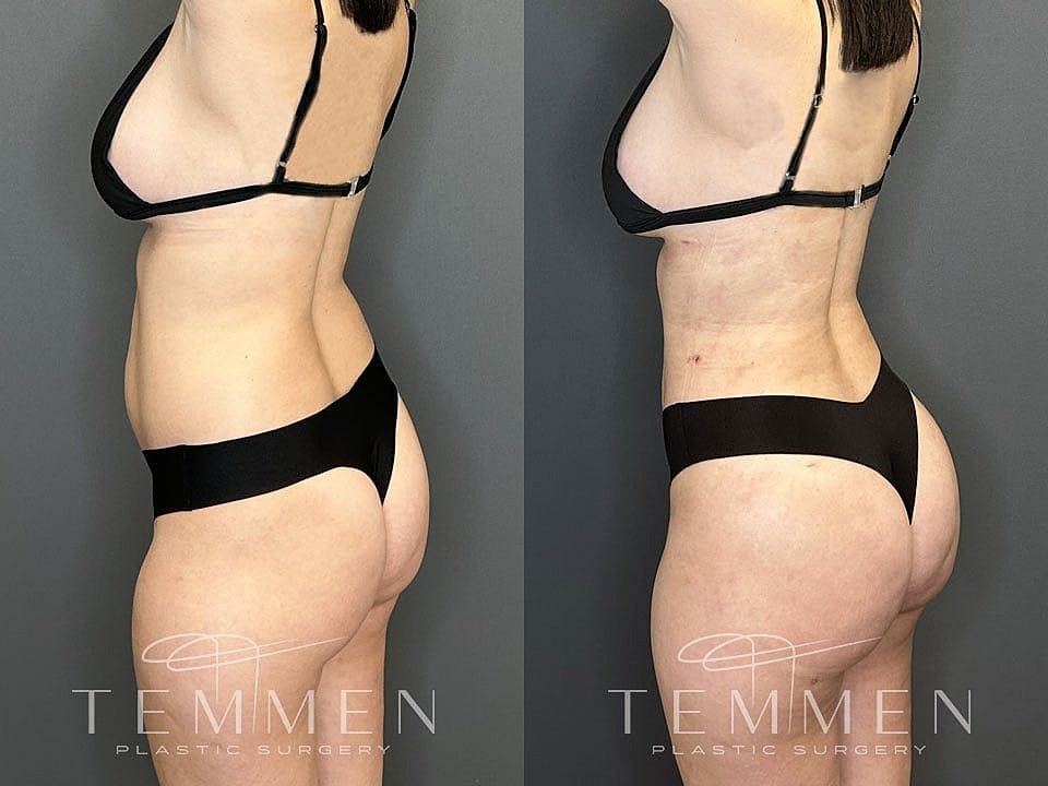 Liposuction Before & After