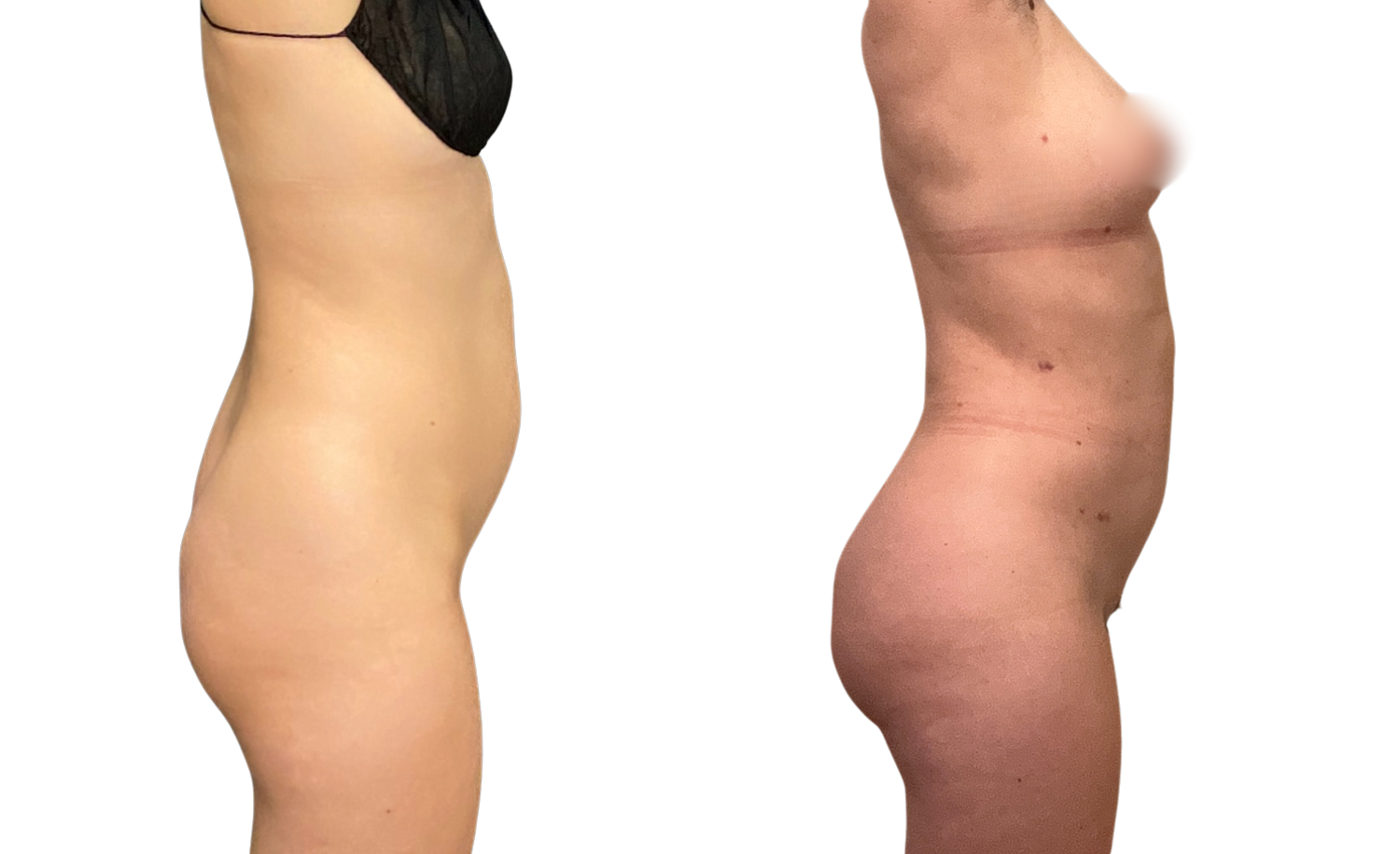 Liposuction Before & After