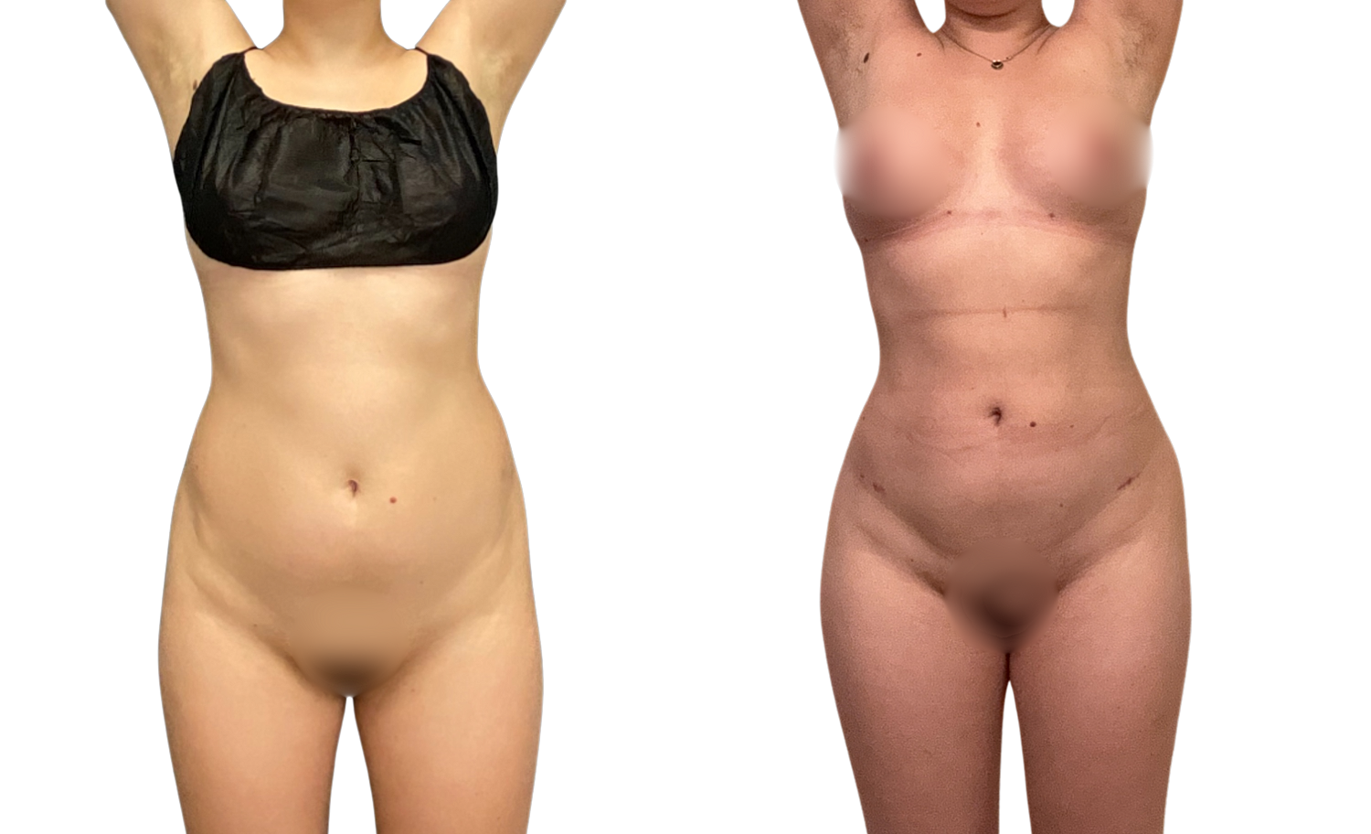 Liposuction Before & After