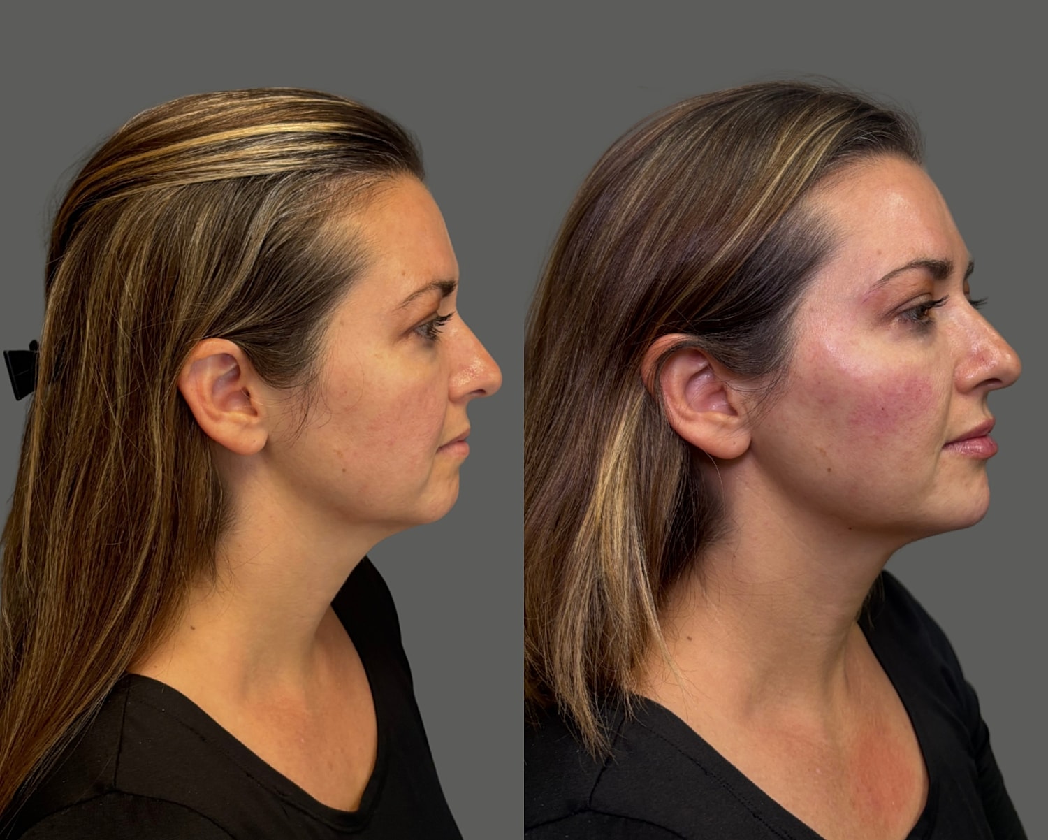 Cheek Filler Before & After
