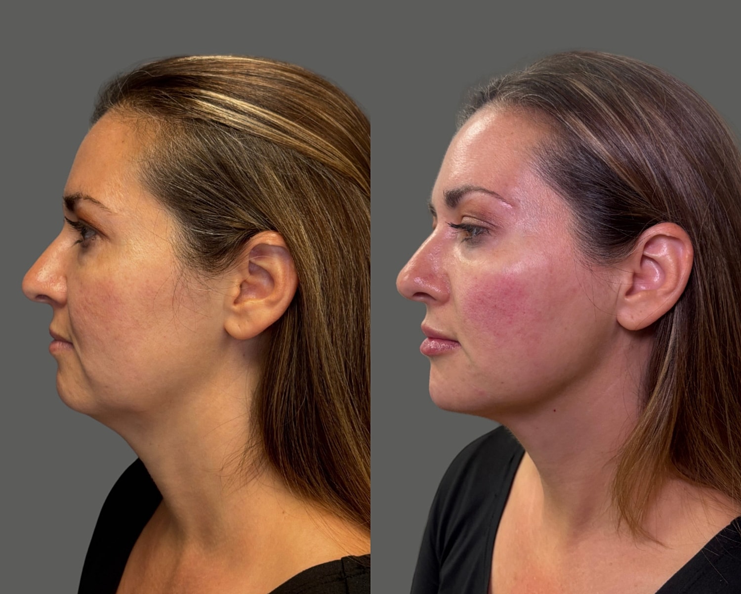 Cheek Filler Before & After
