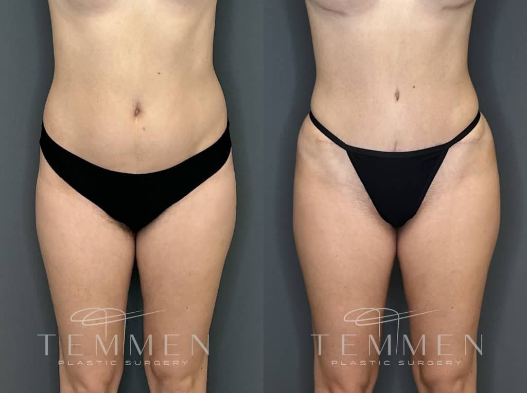 Tummy Tuck Before & After