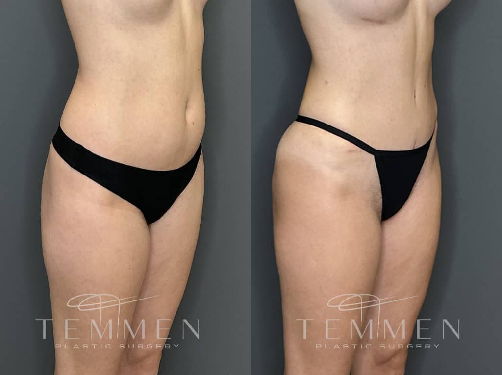 Tummy Tuck Before & After