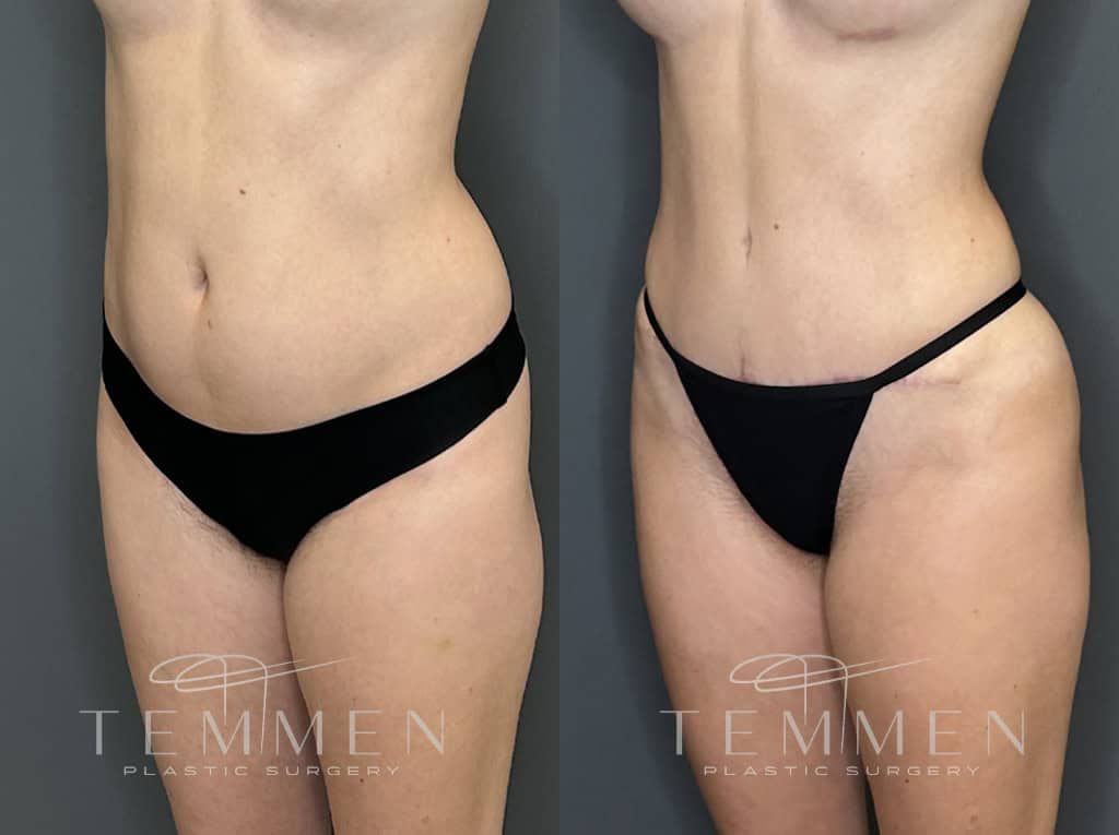 Tummy Tuck Before & After