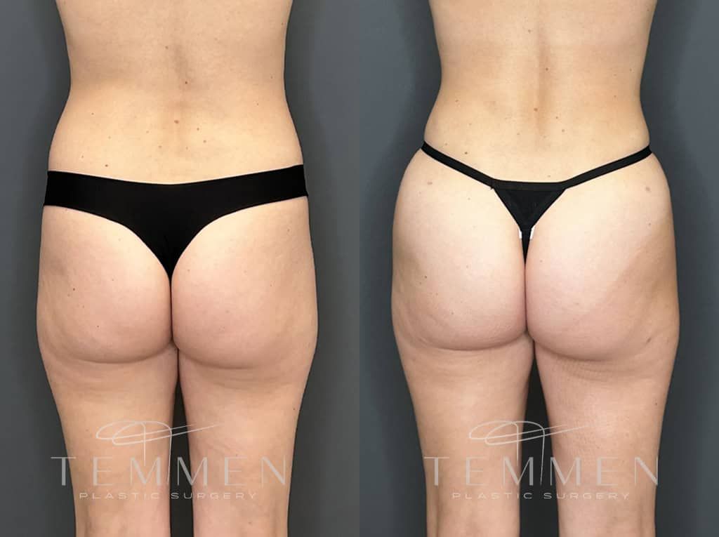 Tummy Tuck Before & After
