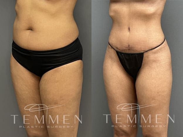 Tummy Tuck Before & After