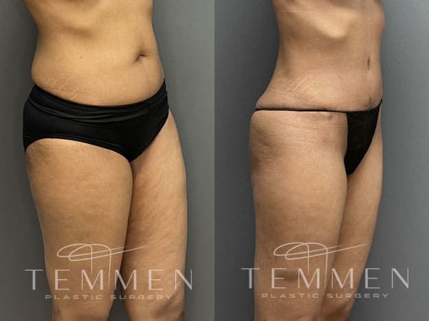 Tummy Tuck Before & After