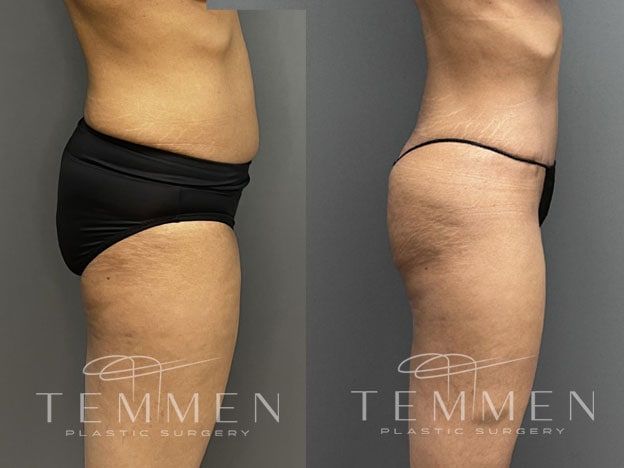 Tummy Tuck Before & After