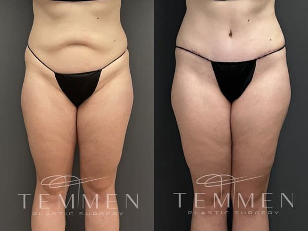 Tummy Tuck Before & After