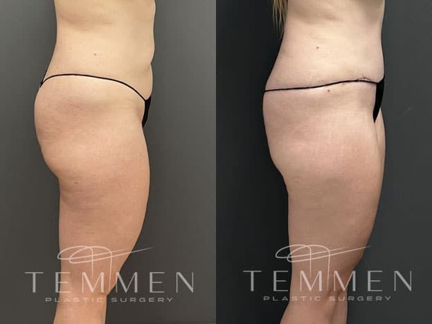 Tummy Tuck Before & After