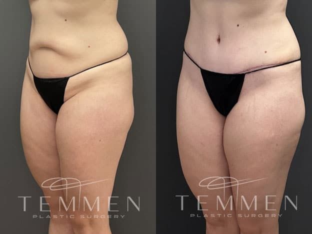 Tummy Tuck Before & After