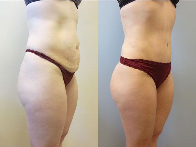 Tummy Tuck Before & After