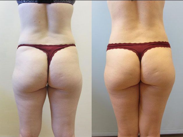 Tummy Tuck Before & After