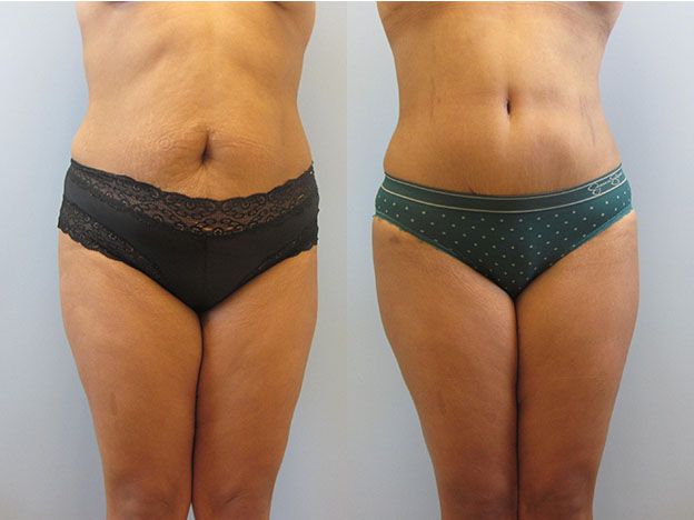 Tummy Tuck Before & After