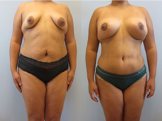 Tummy Tuck Before & After
