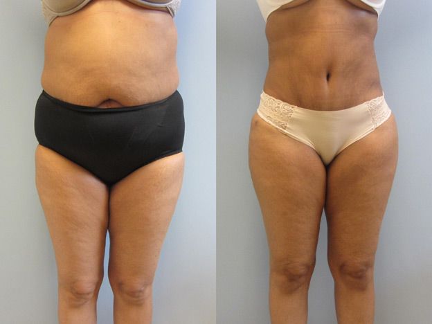 Tummy Tuck Before & After